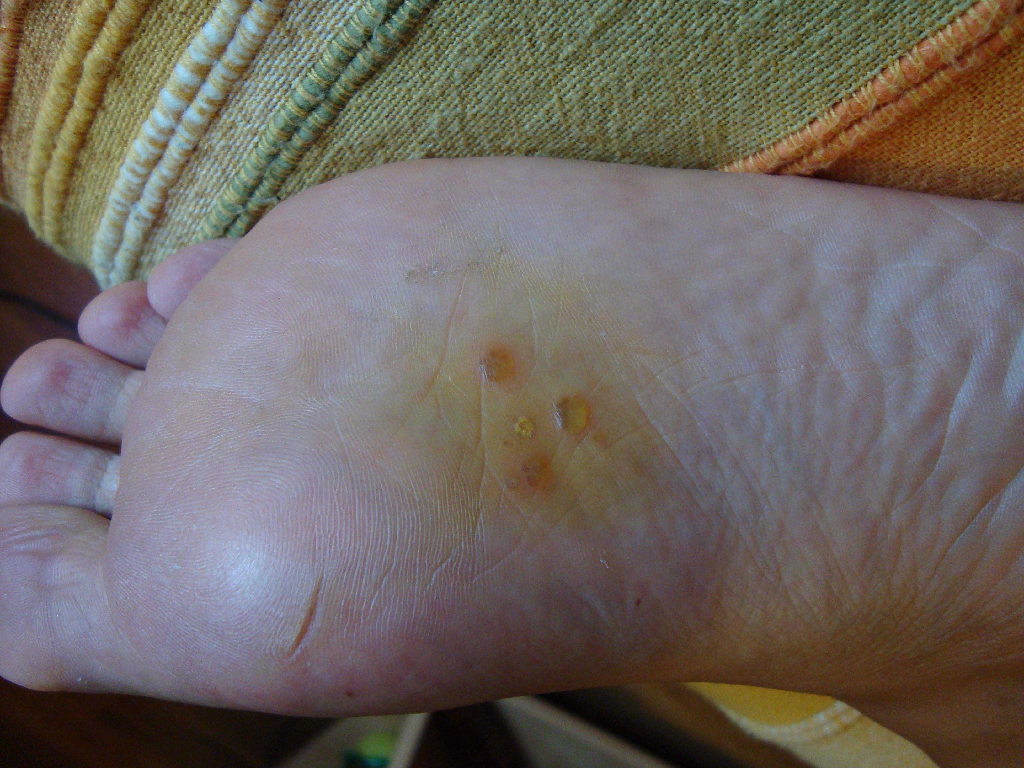 demangeaison sous le pied demangeaison sous le pied
